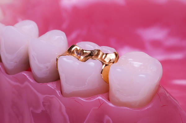 Indications That Your Tooth May Require An Inlay Rather Than A Filling